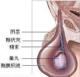 鞘膜积液翻转术—针对睾丸病变 无痛解决鞘膜积液